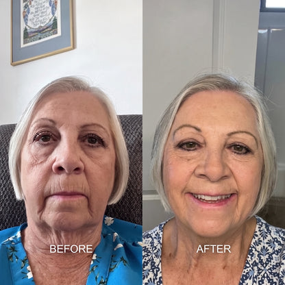 The Revoria Micro Infusion Kit™