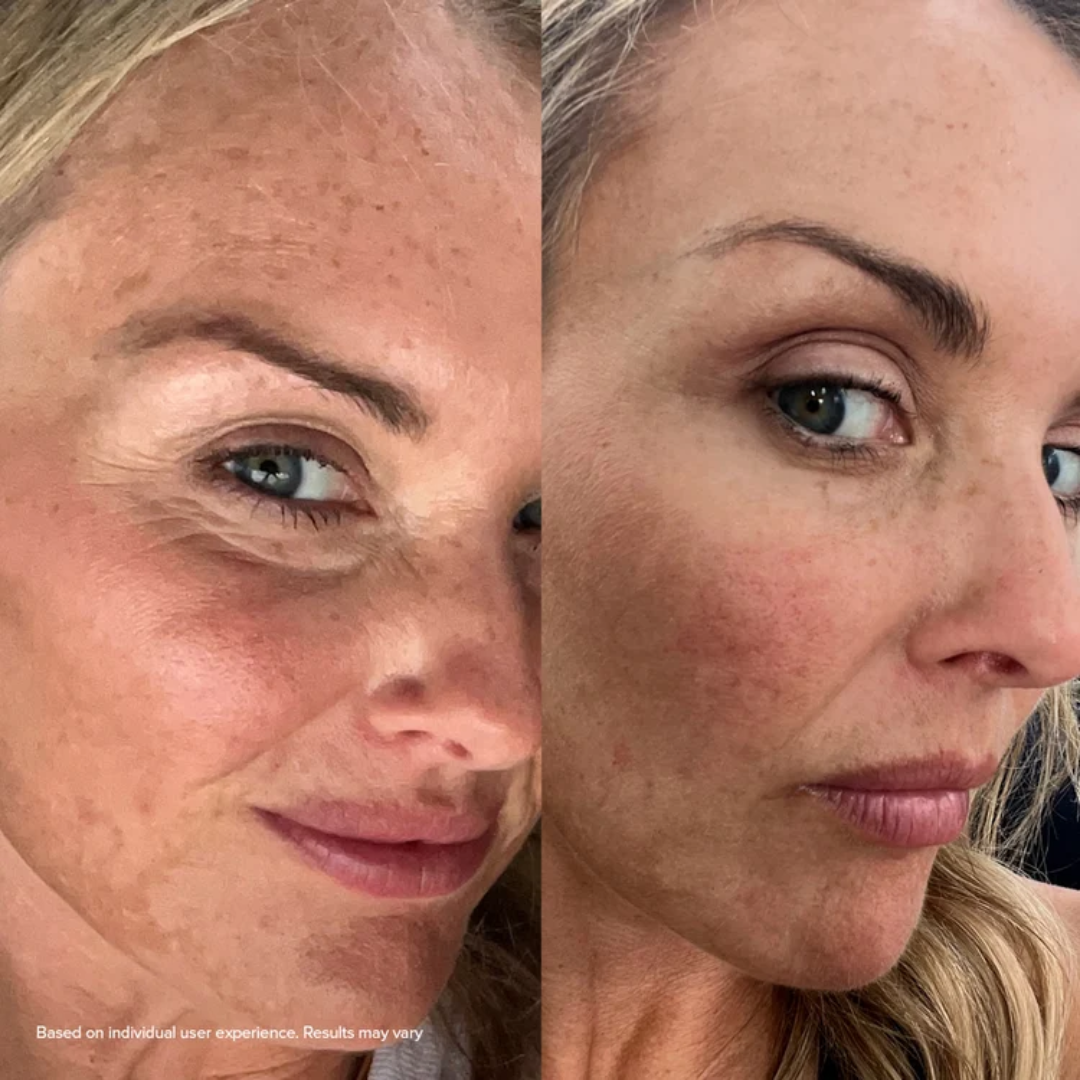 The Revoria Micro Infusion Kit™