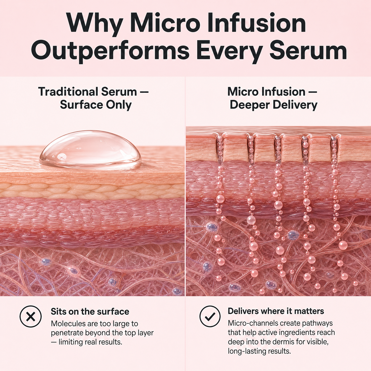 The Revoria Micro Infusion Kit™